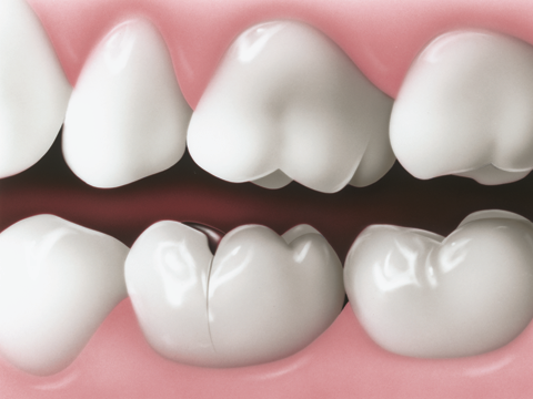 Cracked tooth - dental molar